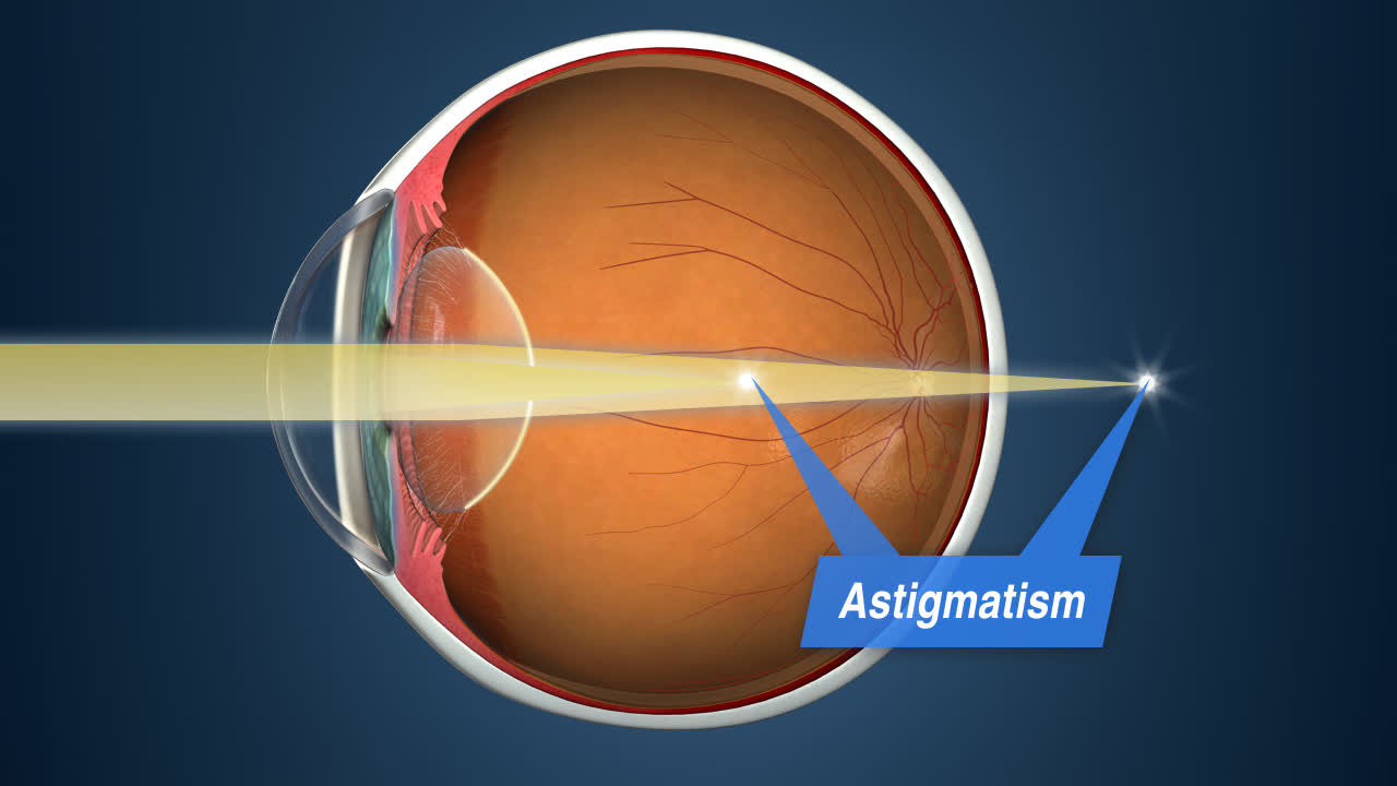 Ortho K Procedure: Your Guide to Better Vision